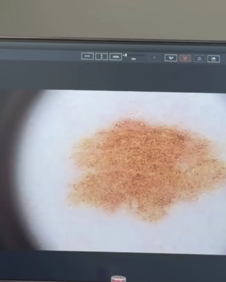 Lo schermo del videodermatoscopio: un neo ingrandito, per seguirlo nel tempo