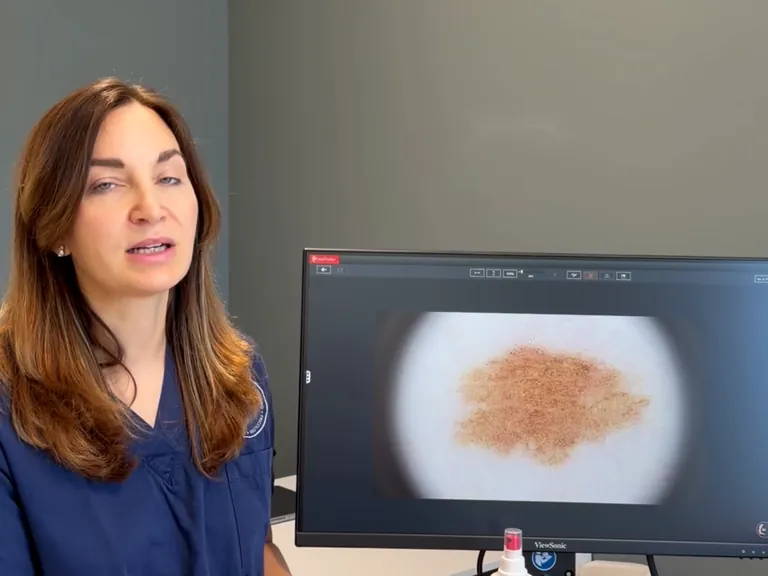 Una dottoressa della squadra accanto allo schermo del videodermatoscopio, che mostra un neo ingrandito